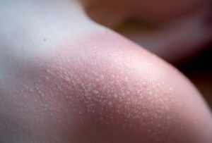 Bị bỏng nắng khi đi du lịch