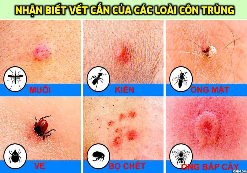 Bị côn trùng cắn khi đi du lịch