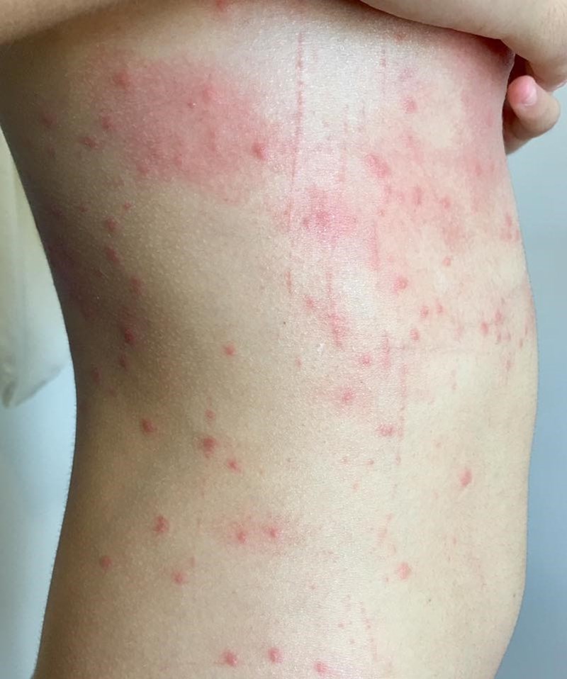 Bị dị ứng khi đi du lịch - Hình 2