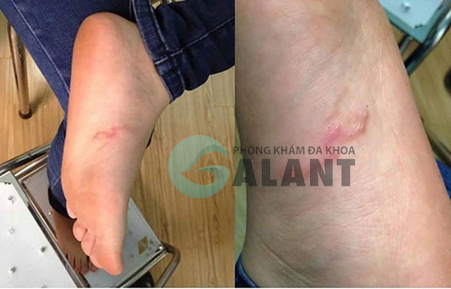 Bị san hô cứa chân phải làm sao - Hình 2