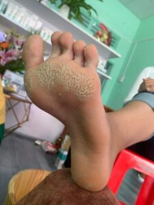 Bị san hô cứa chân phải làm sao