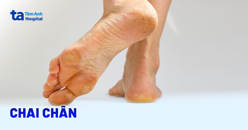 Bị san hô cứa chân phải làm sao - Hình 4