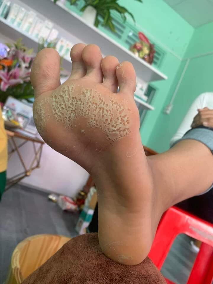 Bị san hô cứa chân phải làm sao - Hình 1