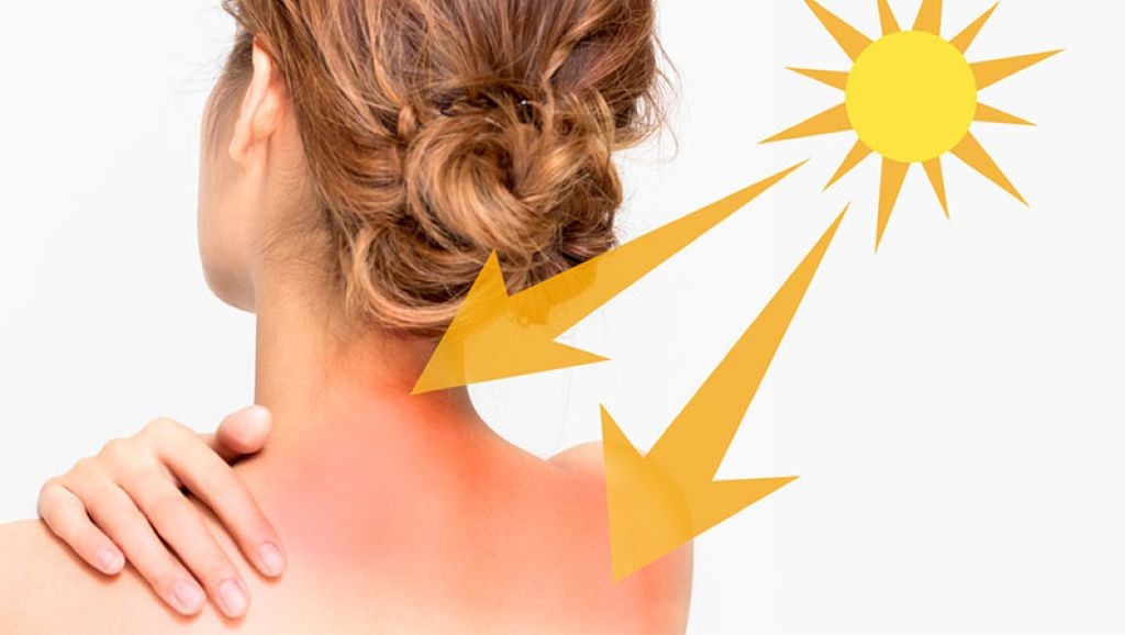 Đi biển bị cháy nắng - Hình 5