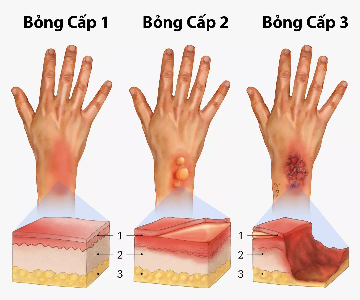 Làm gì khi bị bỏng - Hình 2