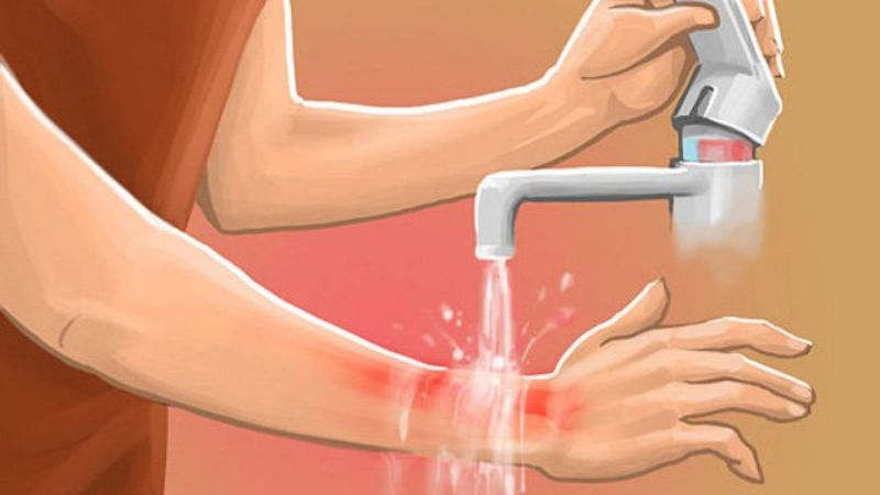 Làm gì khi bị bỏng - Hình 3