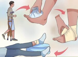 Làm gì khi bị bong gân khi du lịch