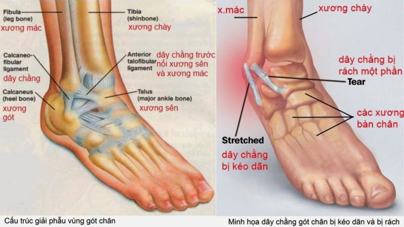 Làm gì khi bị bong gân khi du lịch - Hình 5
