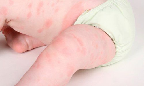 Làm gì khi bị dị ứng thực phẩm - Hình 3