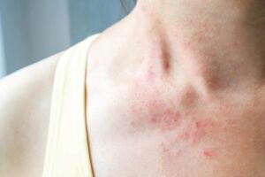 Làm gì khi bị dị ứng thực phẩm