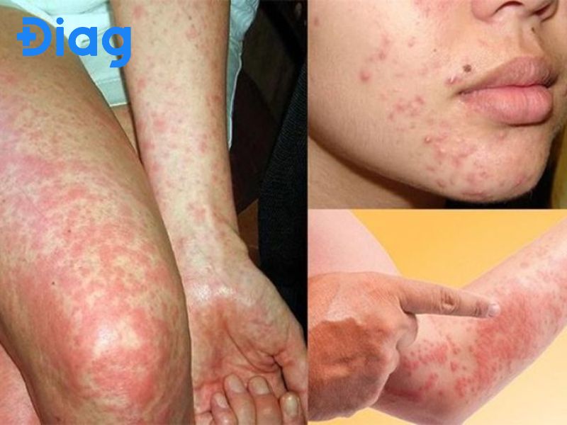Làm gì khi bị dị ứng thực phẩm - Hình 4