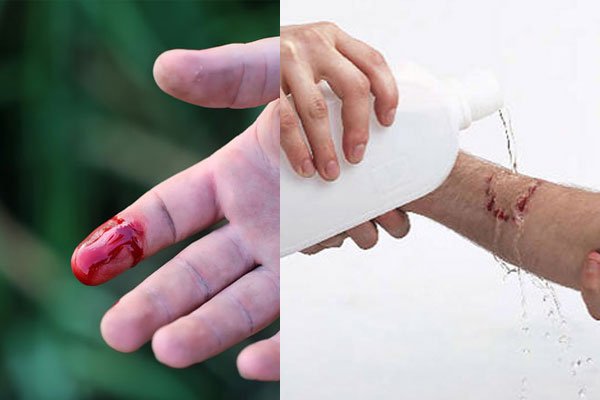 Làm gì khi bị đứt tay khi đi du lịch - Hình 3