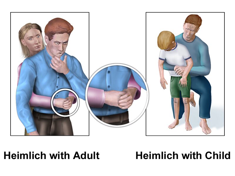 Làm gì khi bị hóc xương cá - Hình 3