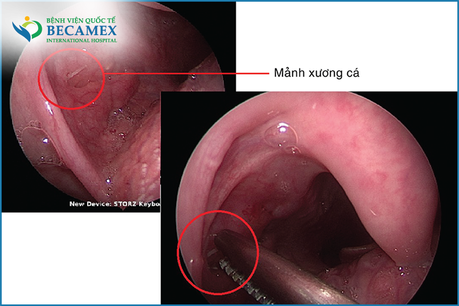 Làm gì khi bị hóc xương cá - Hình 4