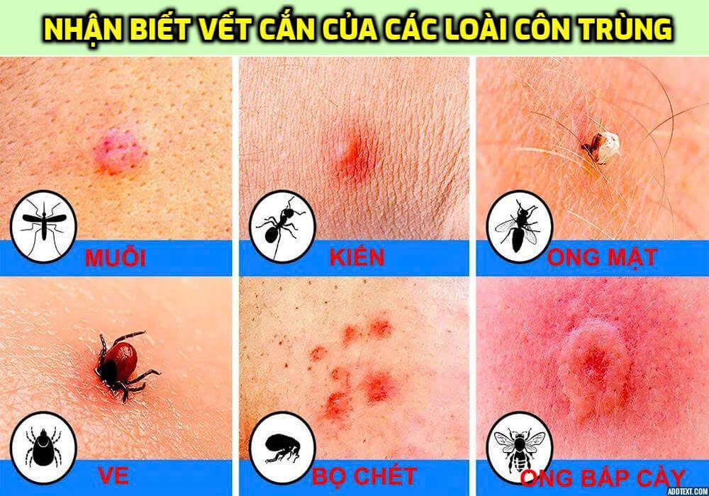 Làm gì khi bị kiến cắn - Hình 2