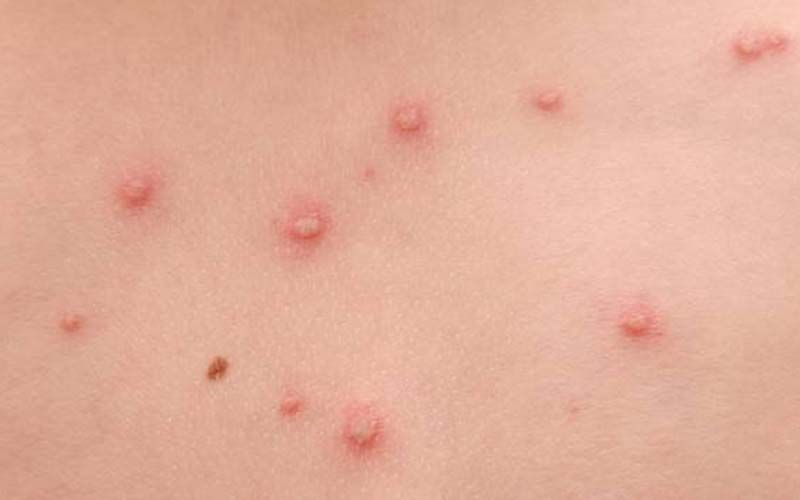 Làm gì khi bị kiến cắn - Hình 5