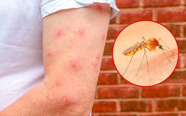 Làm gì khi bị muỗi đốt nhiều - Hình 3