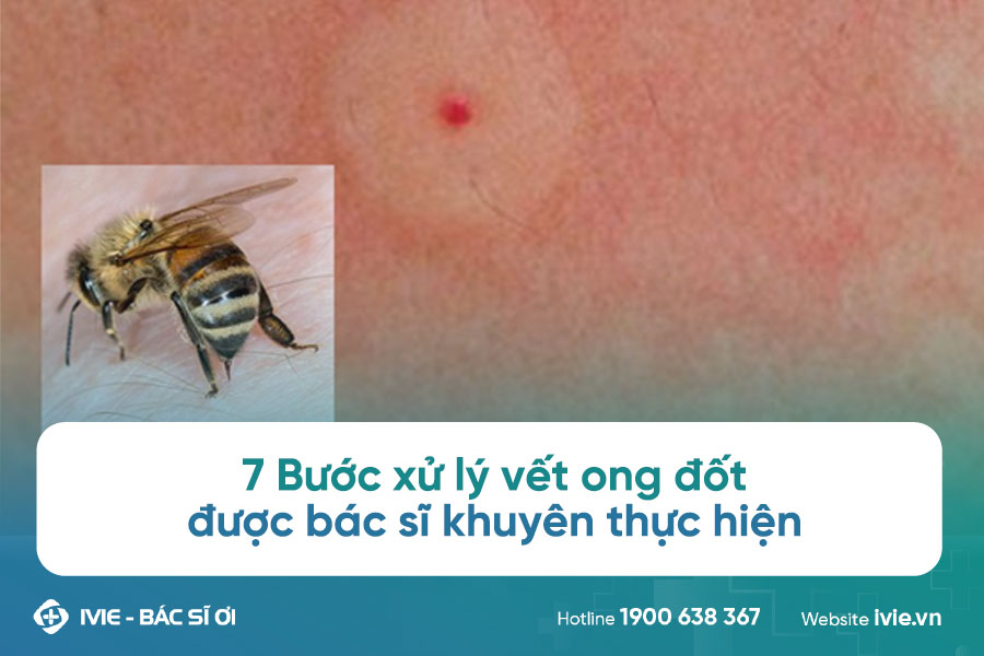 Làm gì khi bị ong đốt