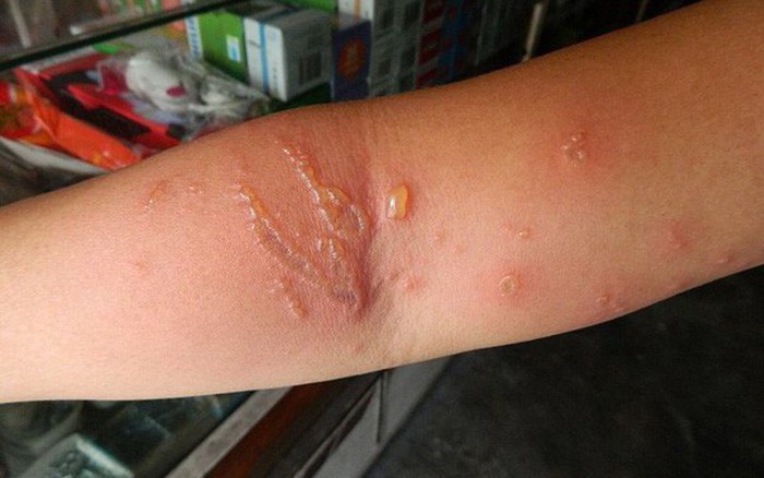 Làm gì khi gặp sứa - Hình 1