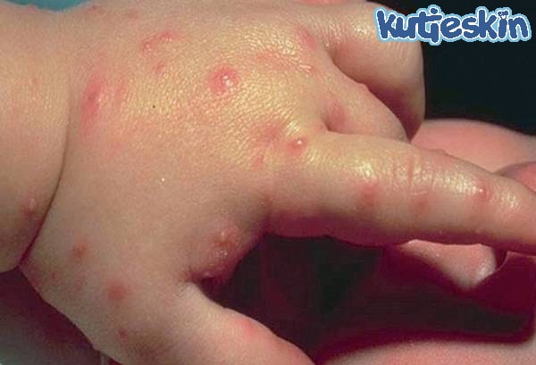 Làm gì khi trẻ bị côn trùng cắn - Hình 5